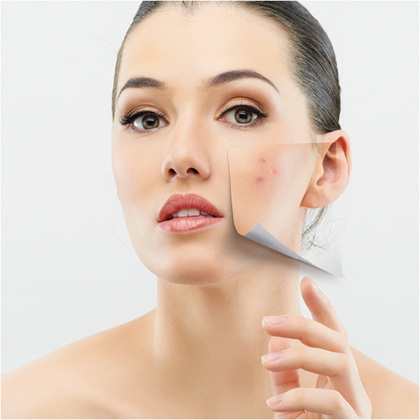 What Are the Causes and Fixes for Acne?